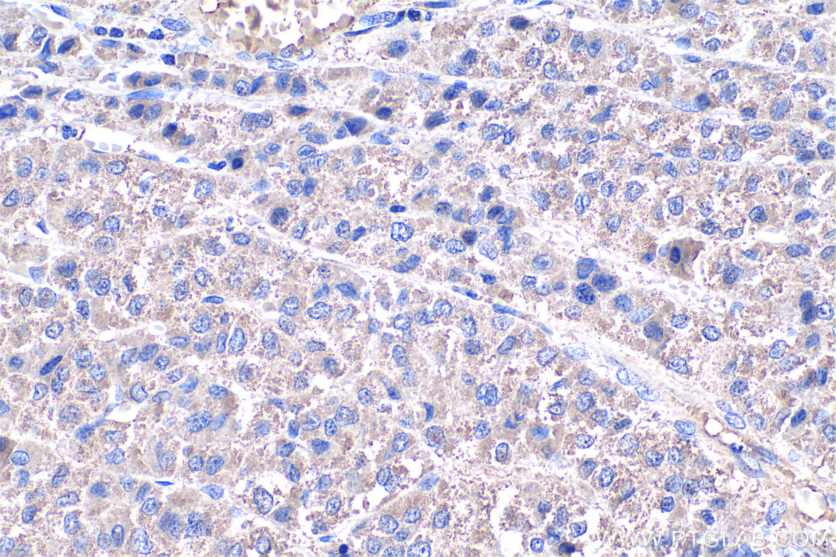 IHC staining of human liver cancer using 66158-1-Ig