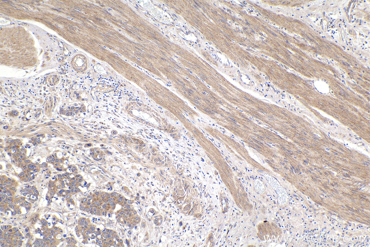 IHC staining of human stomach cancer using 68162-1-Ig