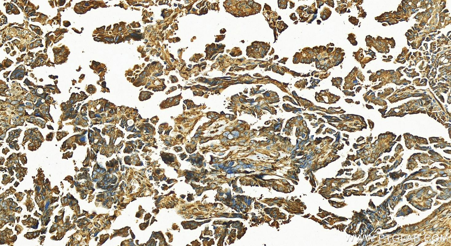 IHC staining of human ovary cancer using 12172-1-AP