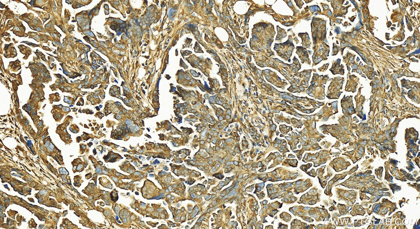 IHC staining of human ovary cancer using 12172-1-AP