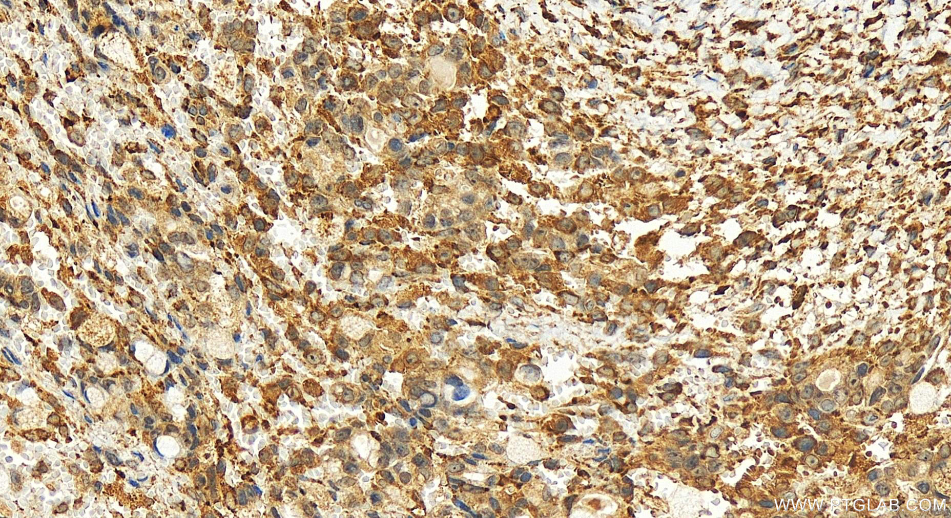 IHC staining of human ovary cancer using 15884-1-AP