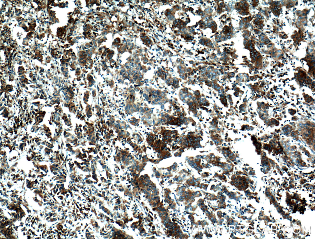 IHC staining of human prostate cancer using 66091-1-Ig