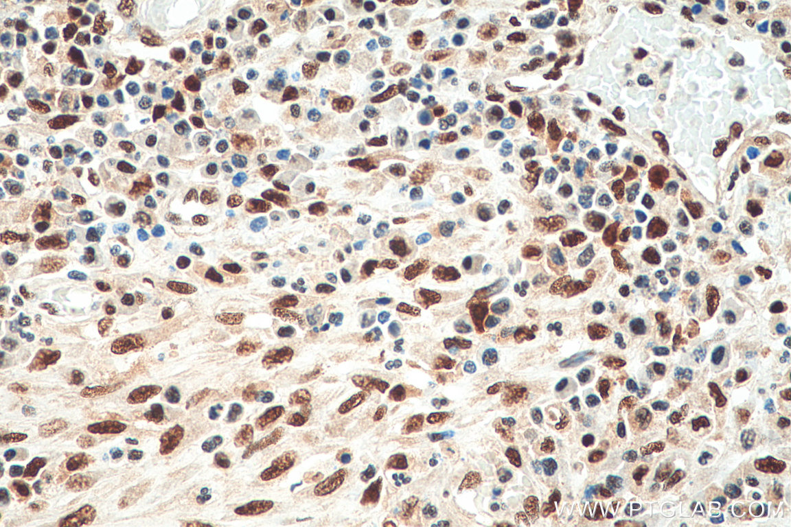 IHC staining of human colon cancer using 67874-1-Ig (same clone as 67874-1-PBS)