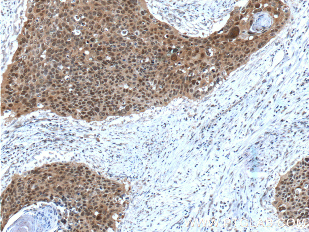 IHC staining of human cervical cancer using 66040-1-Ig