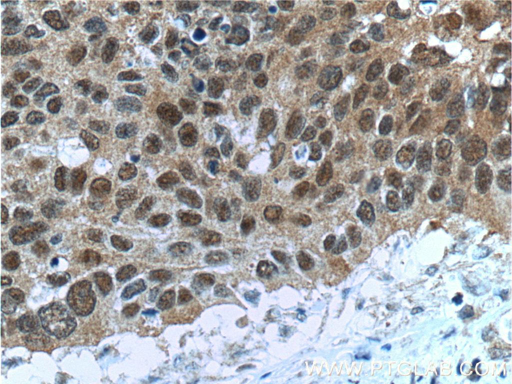 IHC staining of human cervical cancer using 66040-1-Ig