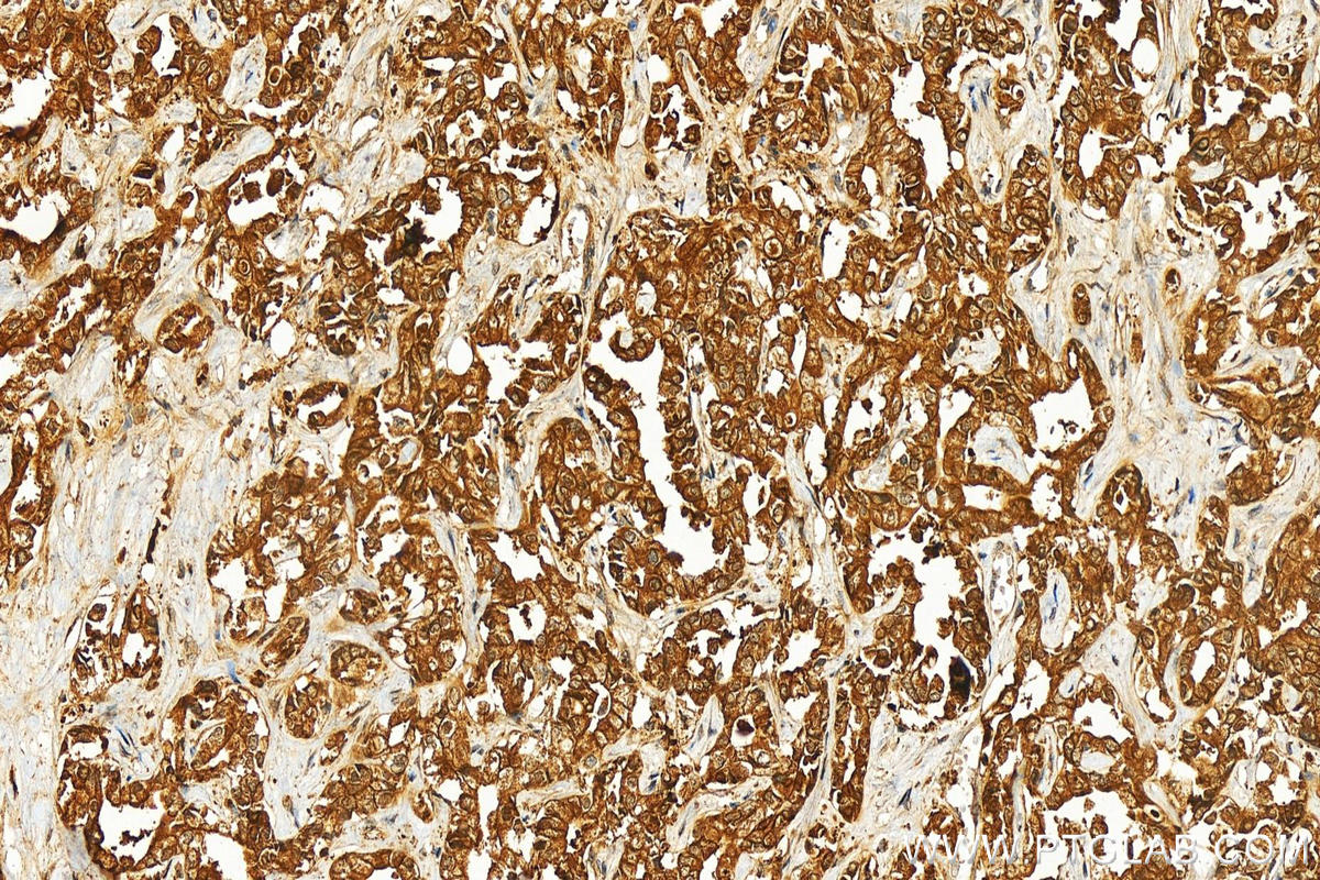 IHC staining of human intrahepatic cholangiocarcinoma using 11236-2-AP