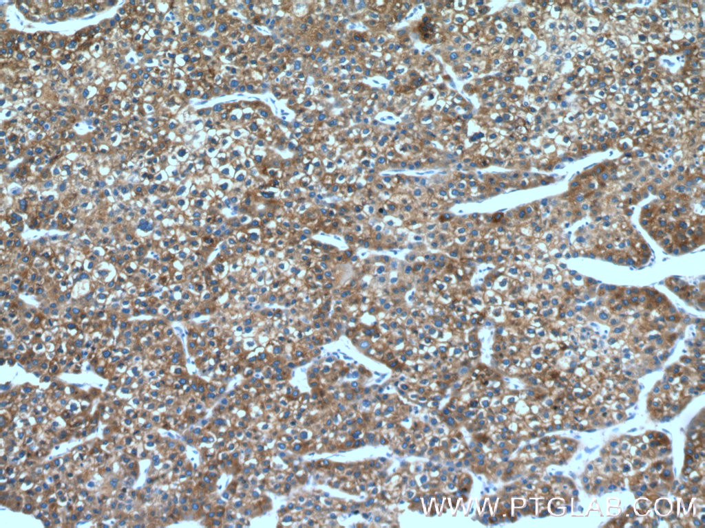 IHC staining of human liver cancer using 17469-1-AP