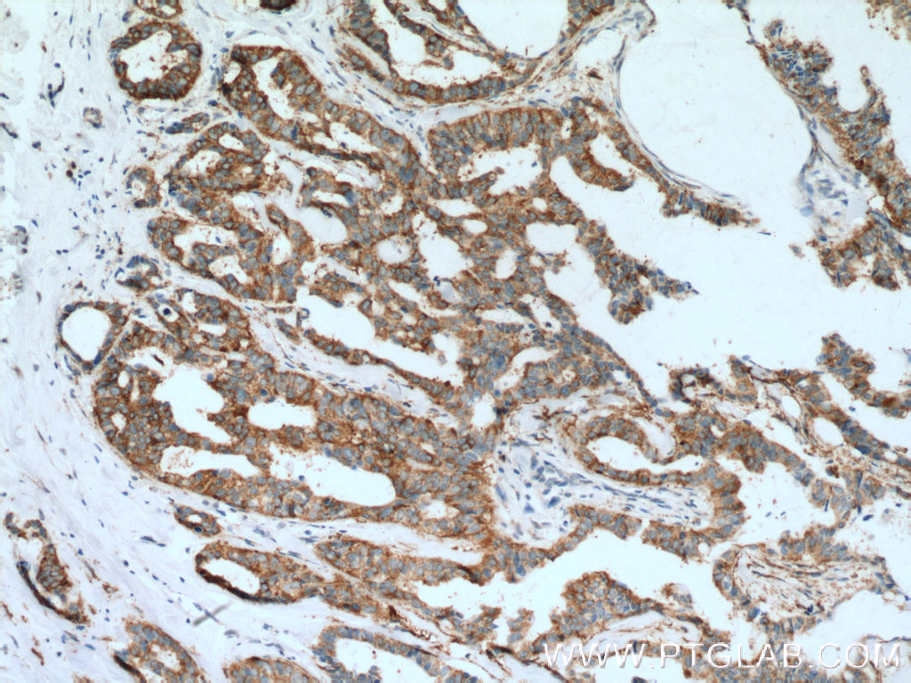 IHC staining of human breast cancer using 13699-1-AP