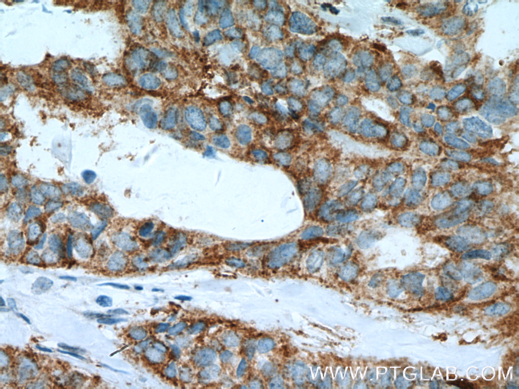 IHC staining of human breast cancer using 13699-1-AP