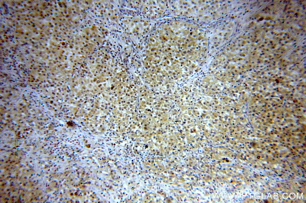 IHC staining of human renal cell carcinoma using 19847-1-AP