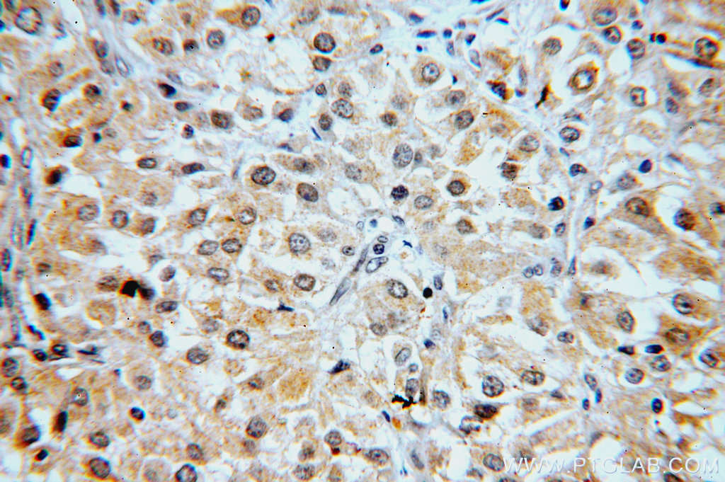 IHC staining of human renal cell carcinoma using 19847-1-AP