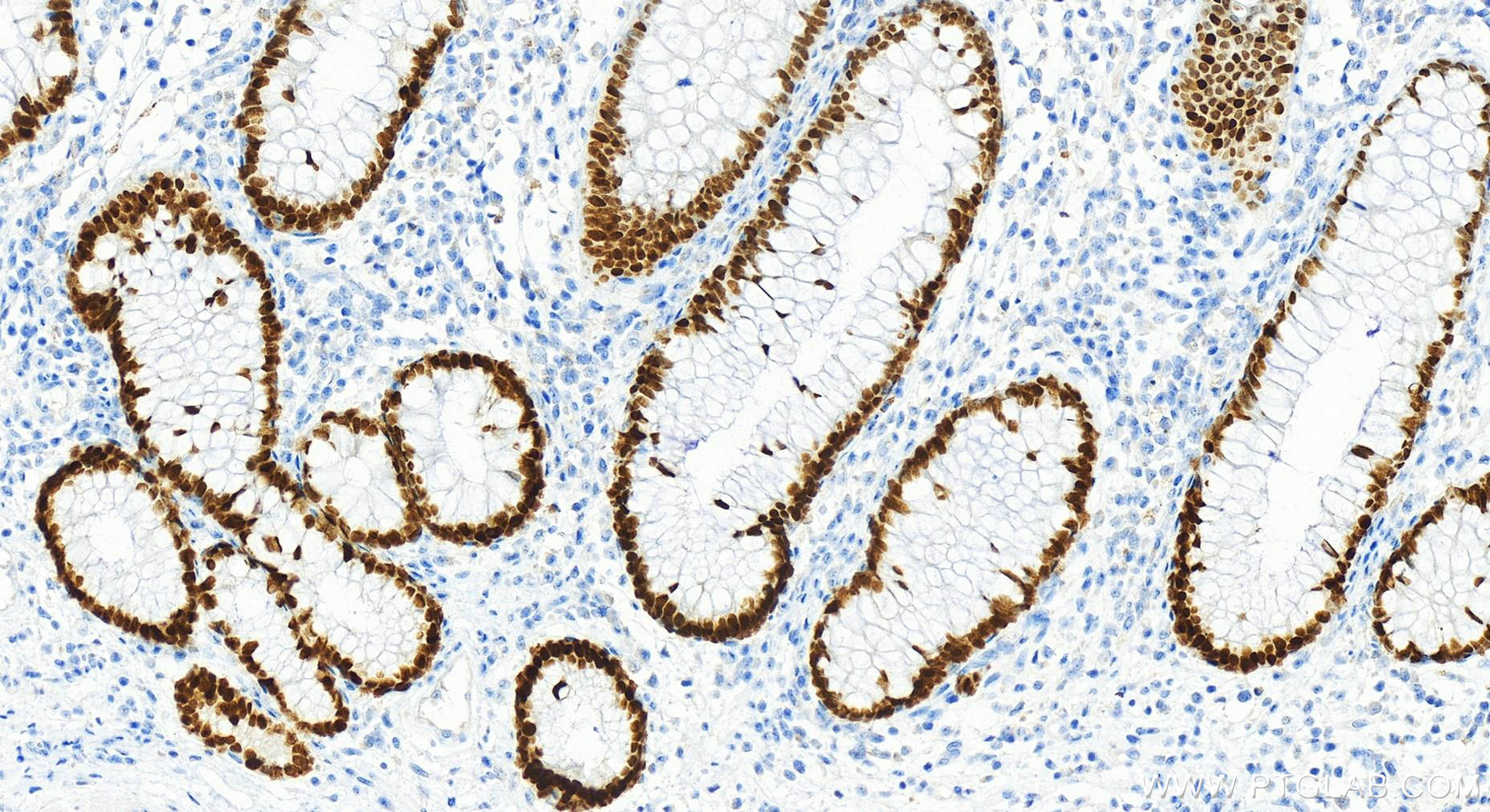 IHC staining of human colon cancer using 22474-1-AP