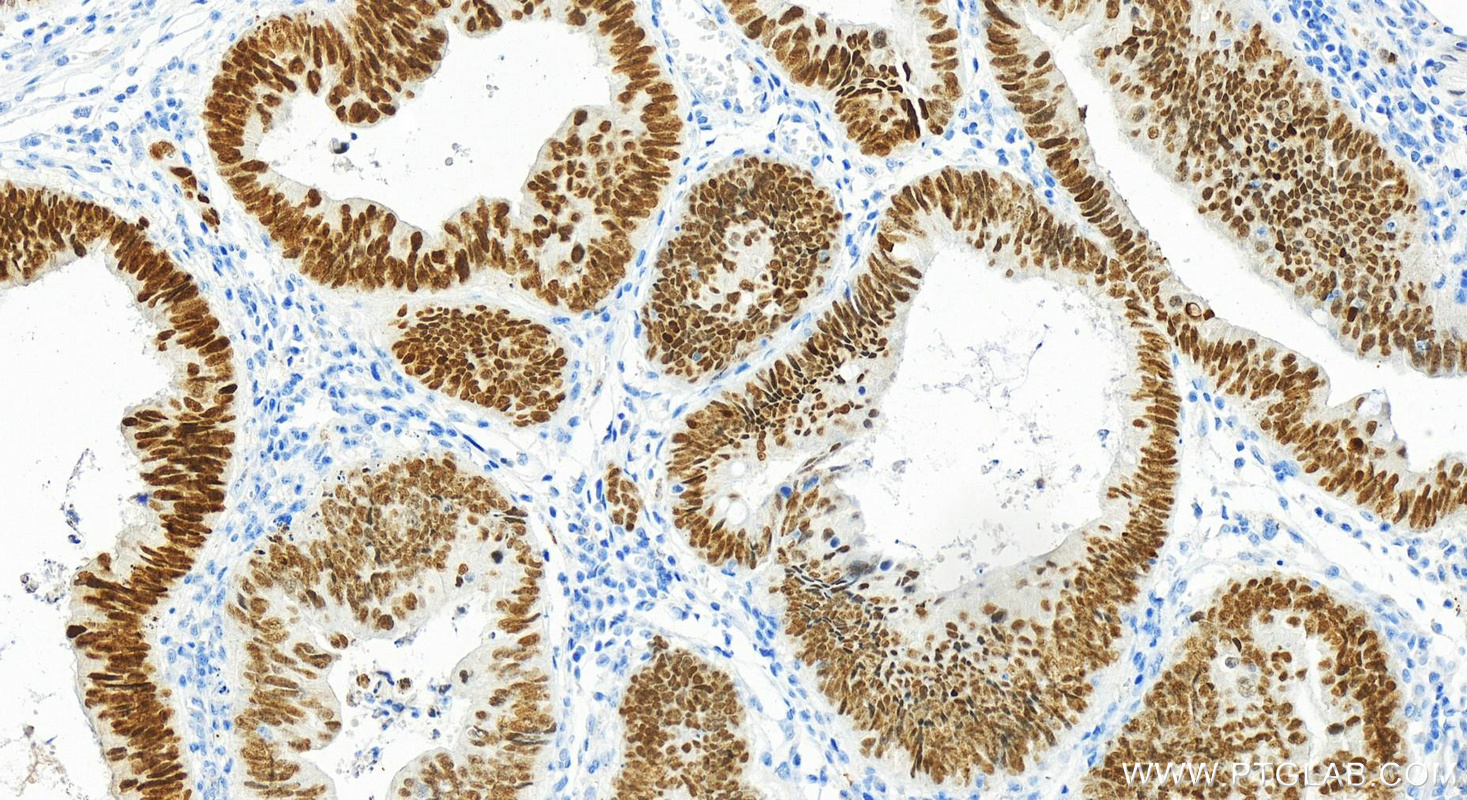 IHC staining of human colon cancer using 22474-1-AP