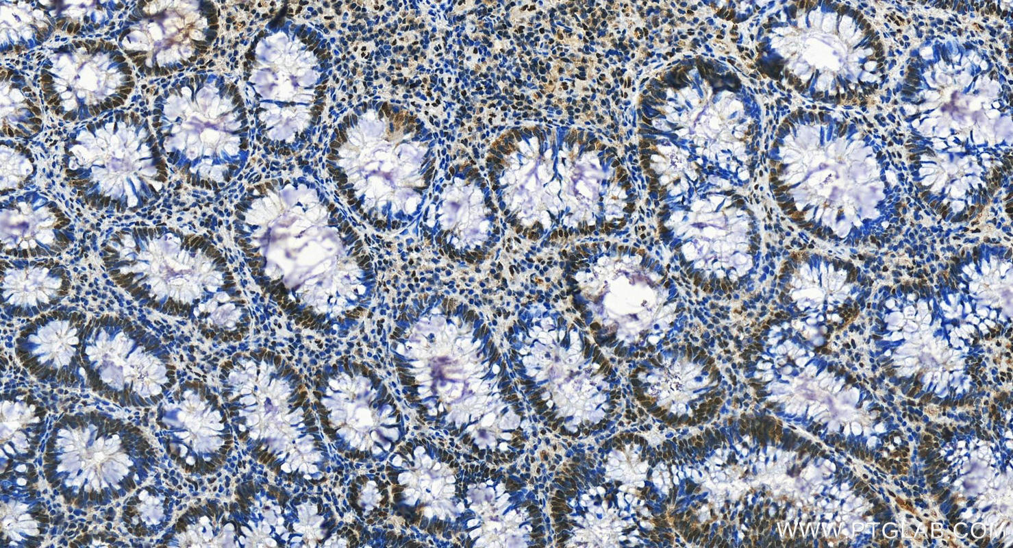 IHC staining of human colon cancer using 29338-1-AP