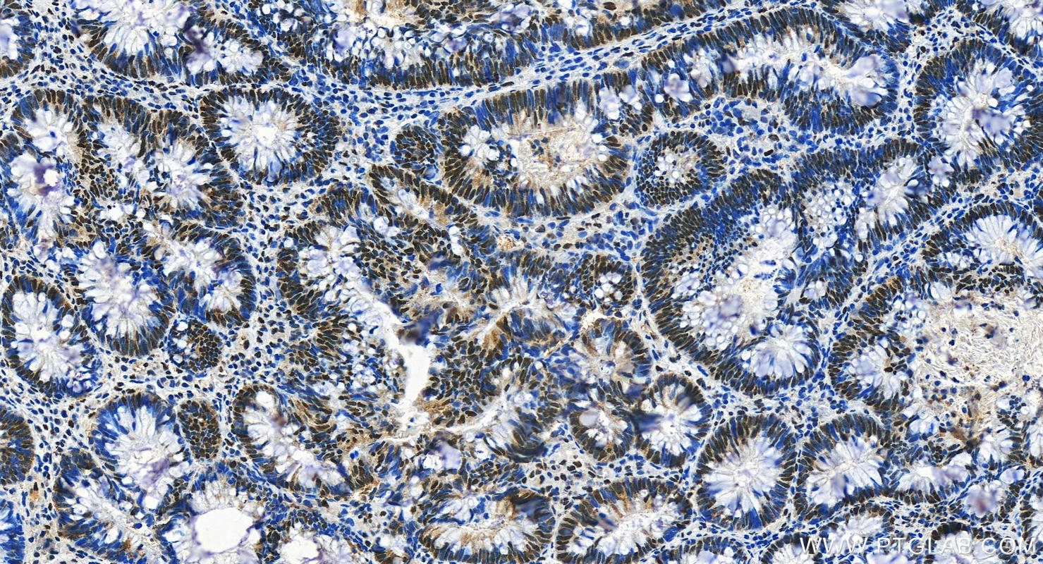 IHC staining of human colon cancer using 29338-1-AP