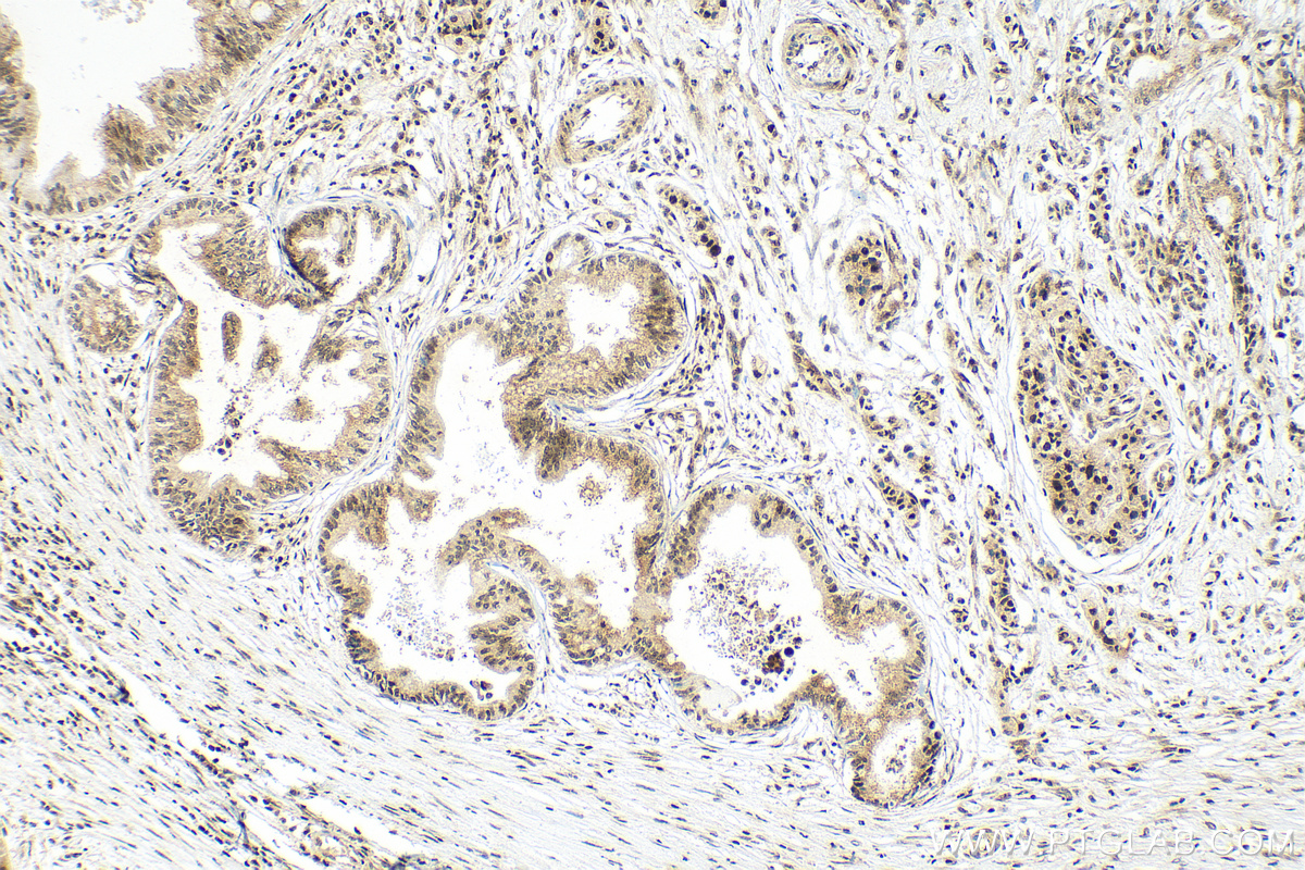 IHC staining of human pancreas cancer using 82997-1-RR (same clone as 82997-1-PBS)