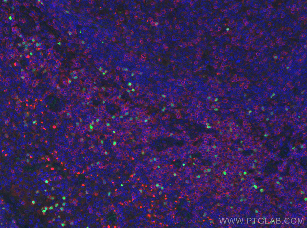 IF Staining of human tonsillitis using 22228-1-AP