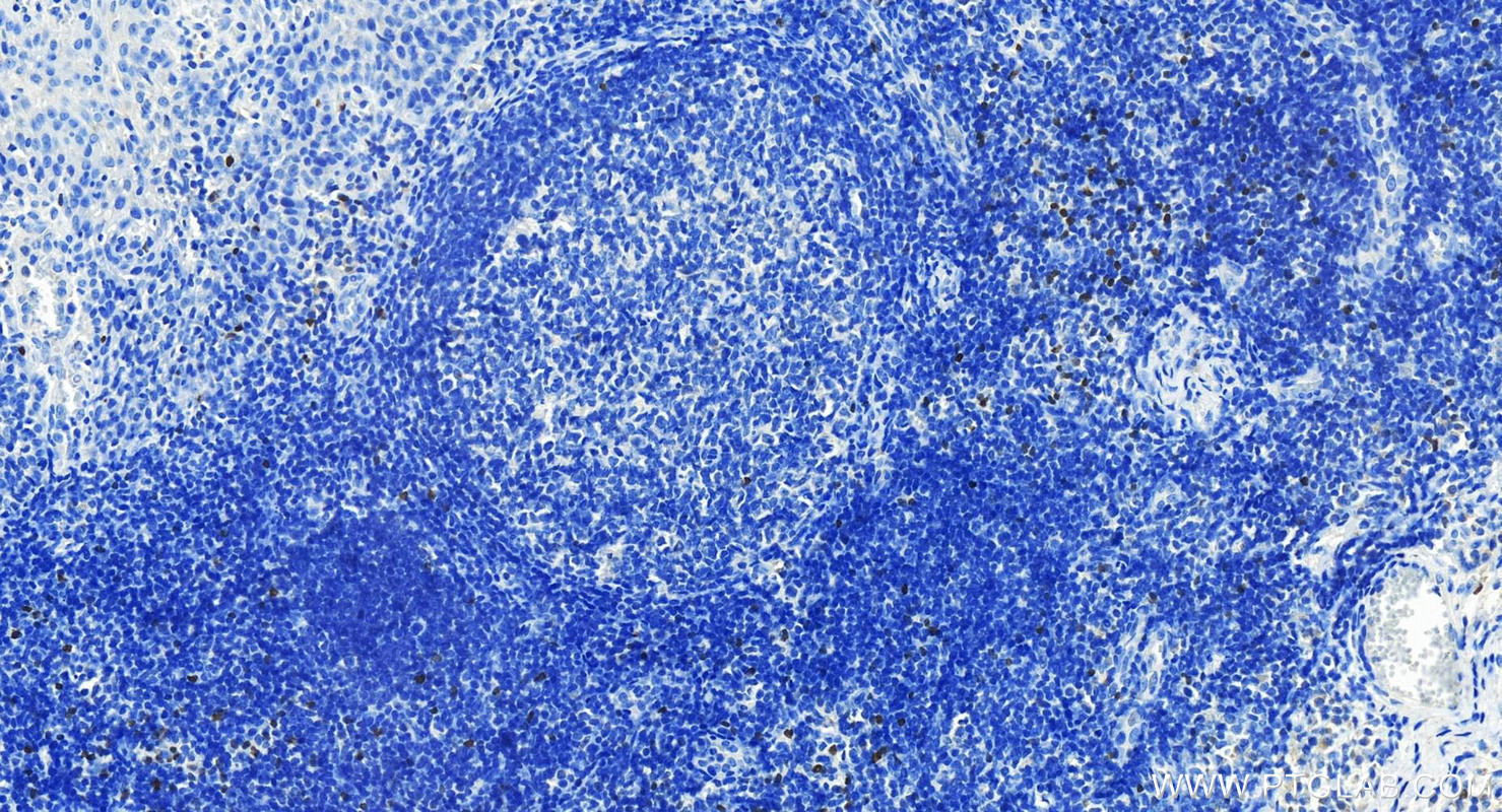 IHC staining of human tonsillitis using 22228-1-AP