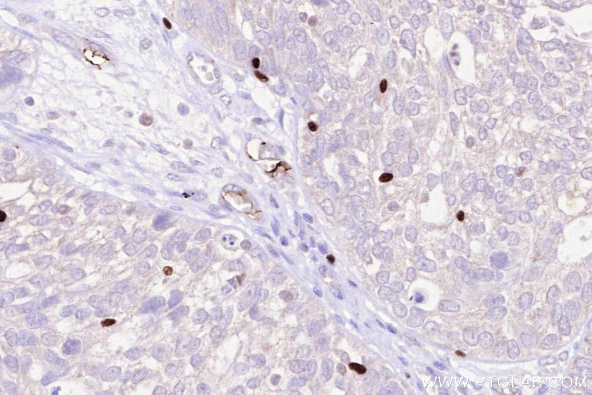 IHC staining of human ovary cancer using 68803-2-Ig