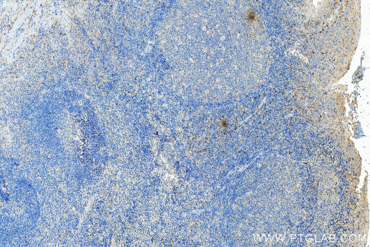 IHC staining of human tonsillitis using 68803-2-Ig