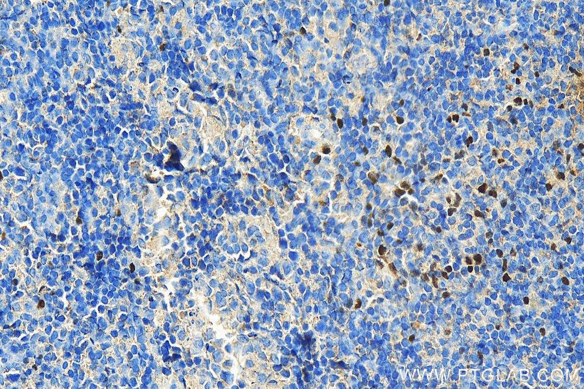 IHC staining of human tonsillitis using 68803-2-Ig