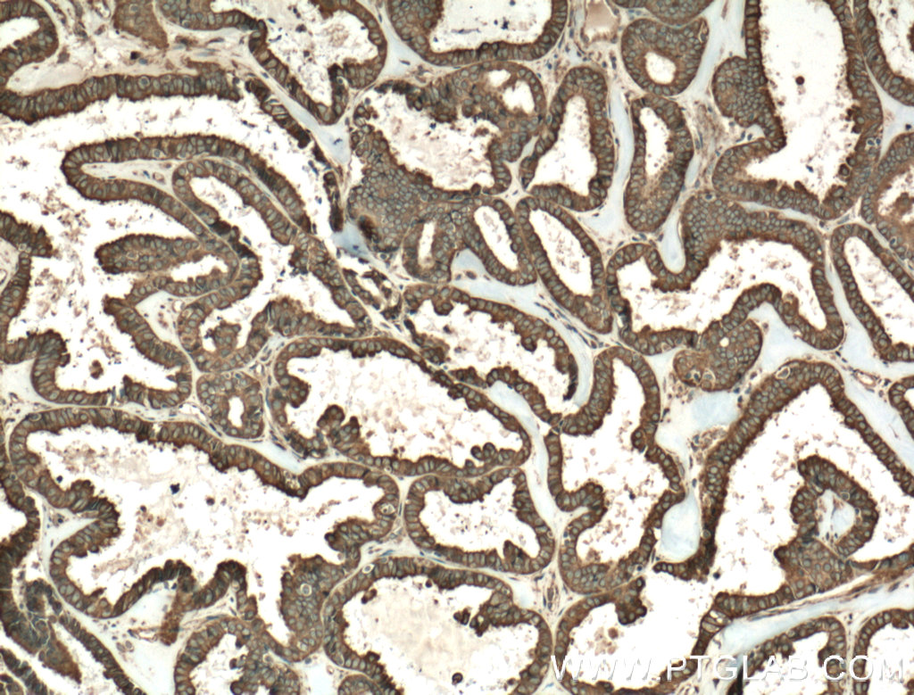 IHC staining of human ovary tumor using 24595-1-AP