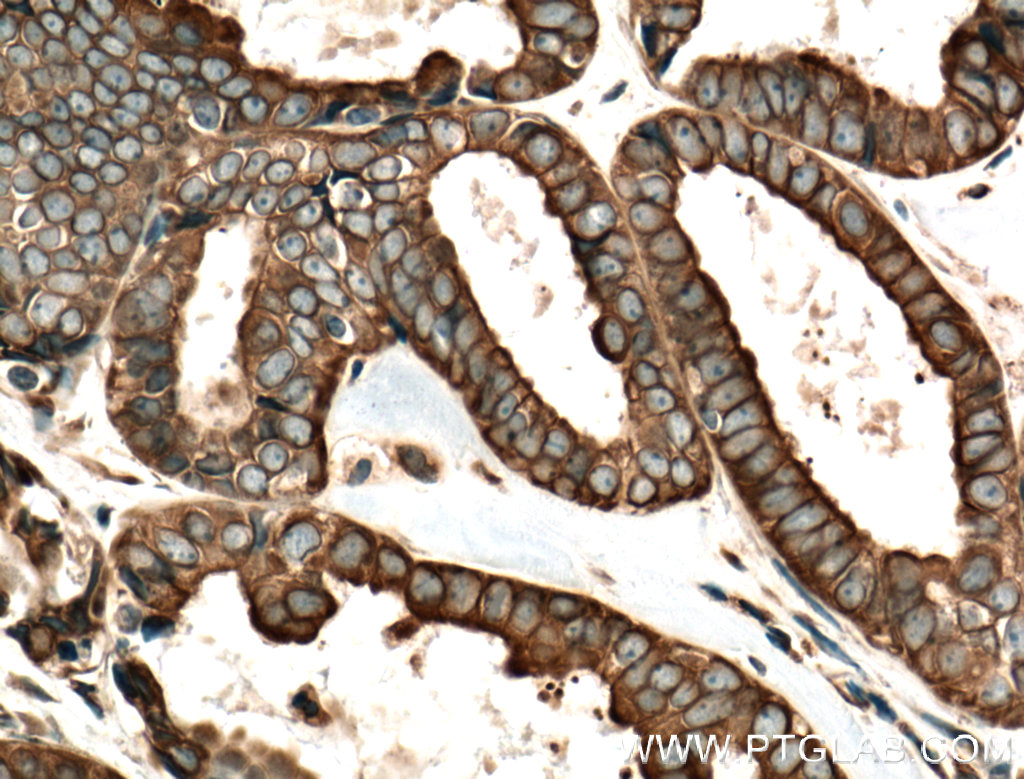 IHC staining of human ovary tumor using 24595-1-AP