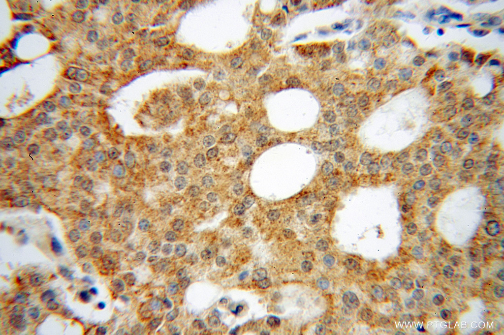 IHC staining of human prostate cancer using 13536-1-AP