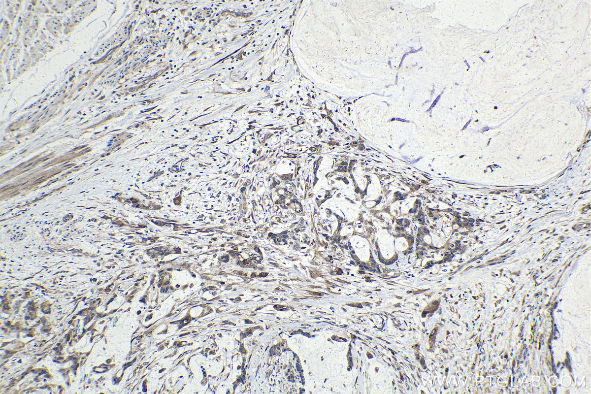 IHC staining of human urothelial carcinoma using 28218-1-AP