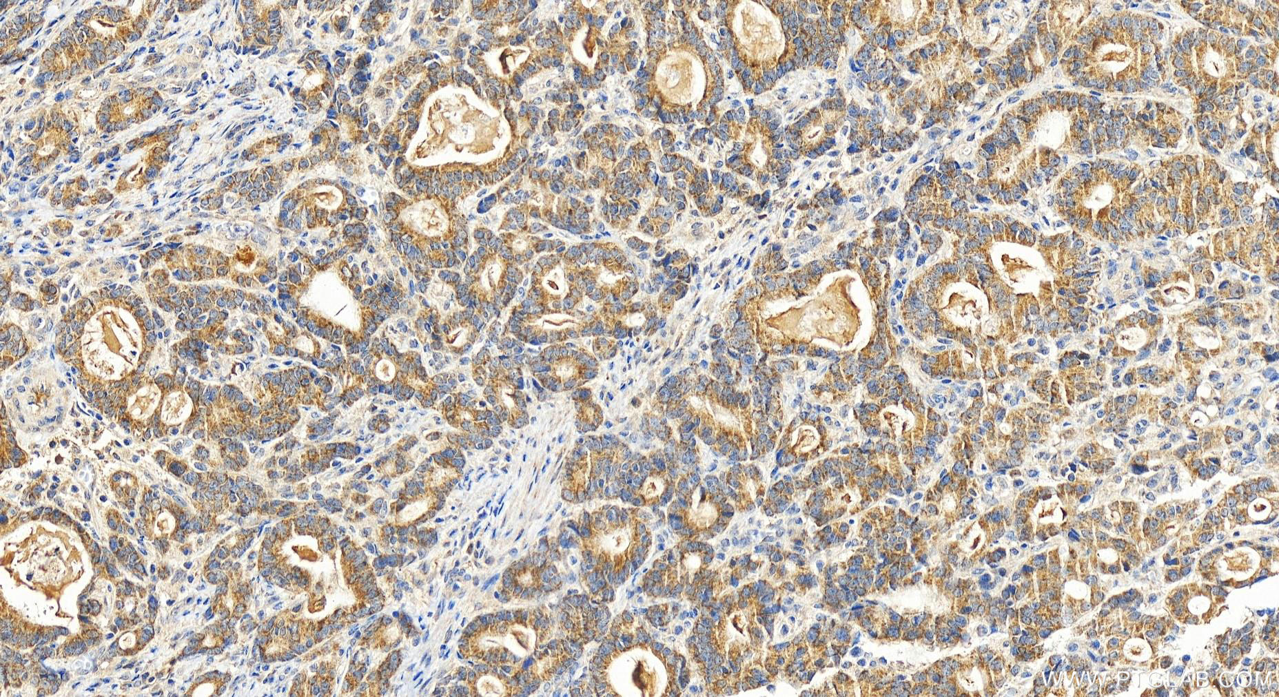 IHC staining of human stomach cancer using 19832-1-AP