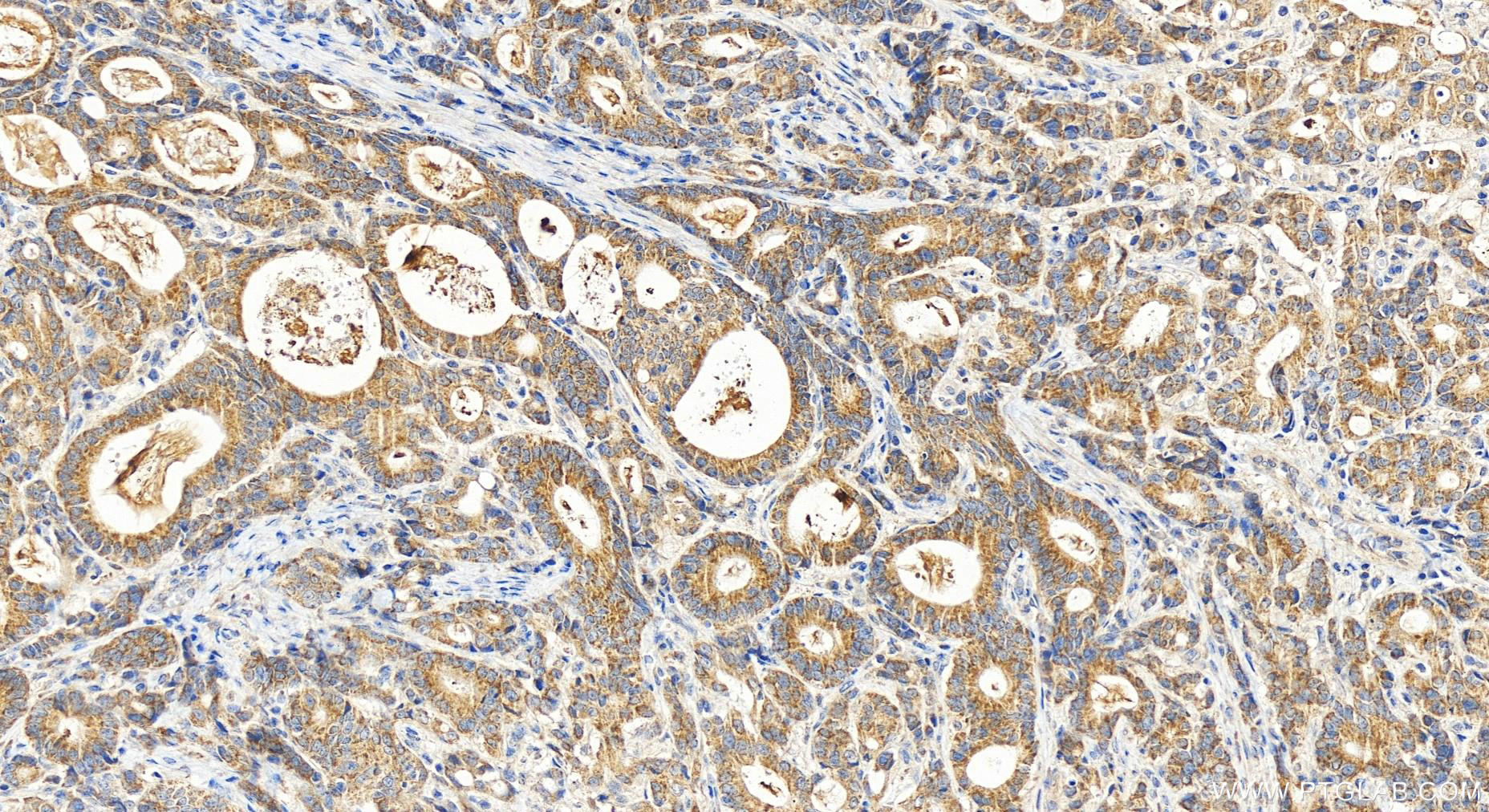 IHC staining of human stomach cancer using 19832-1-AP