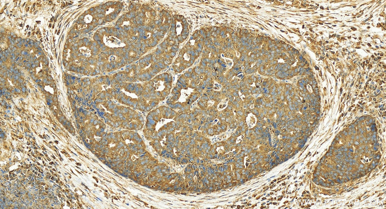 IHC staining of human stomach cancer using 19497-1-AP