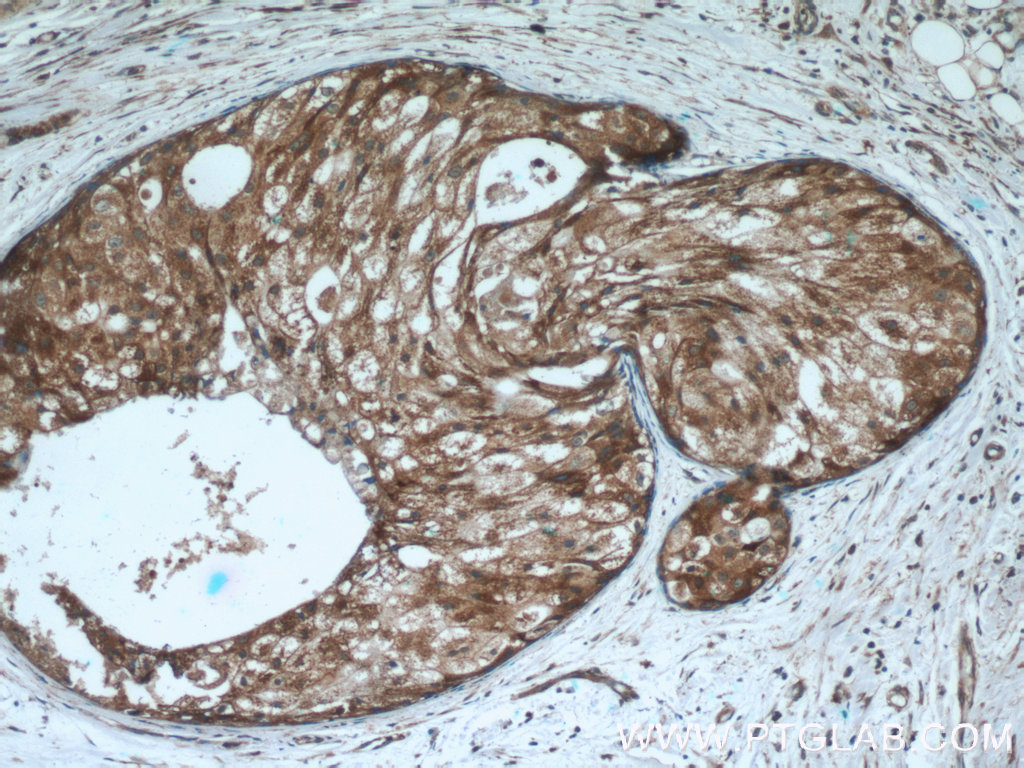 IHC staining of human breast cancer using 18197-1-AP