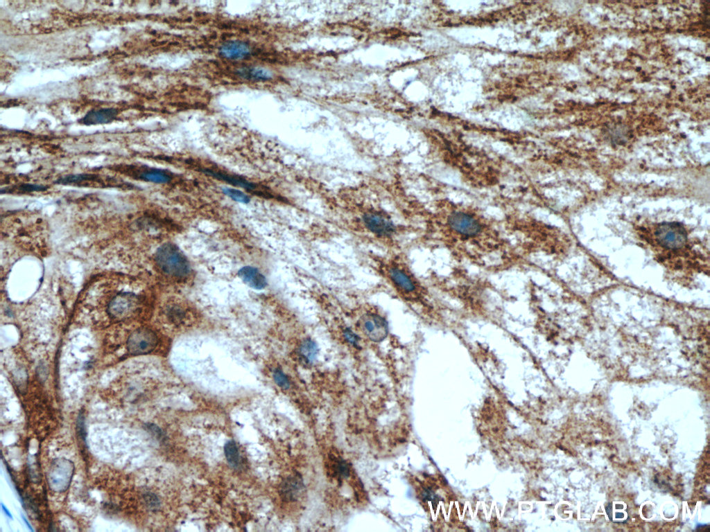 IHC staining of human breast cancer using 18197-1-AP