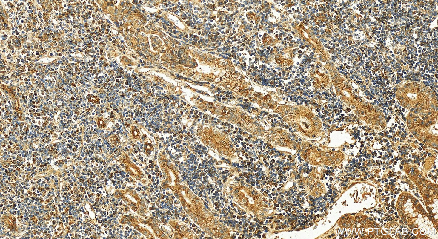 IHC staining of human stomach cancer using 12560-1-AP