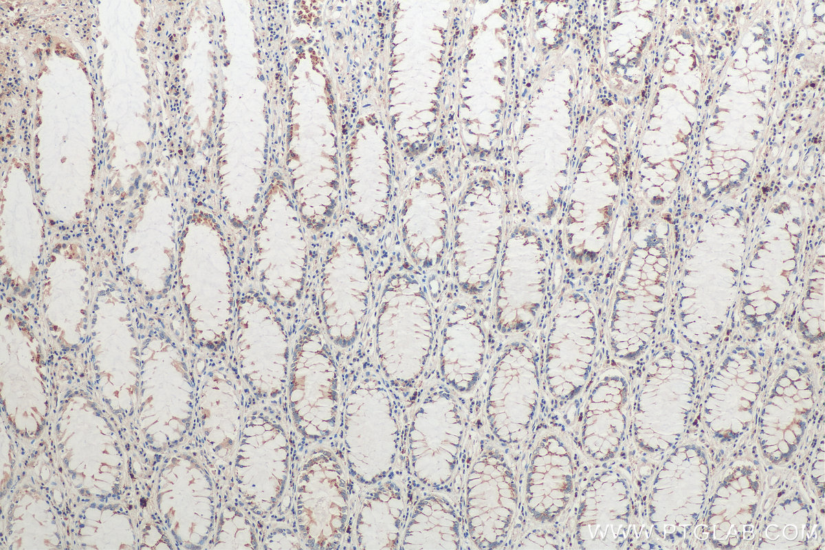 IHC staining of human colon cancer using 66118-1-Ig