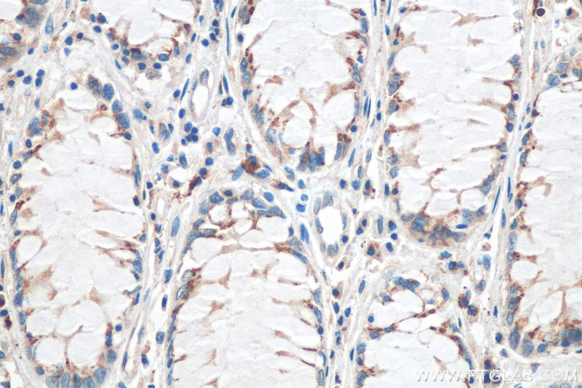 IHC staining of human colon cancer using 66118-1-Ig (same clone as 66118-1-PBS)