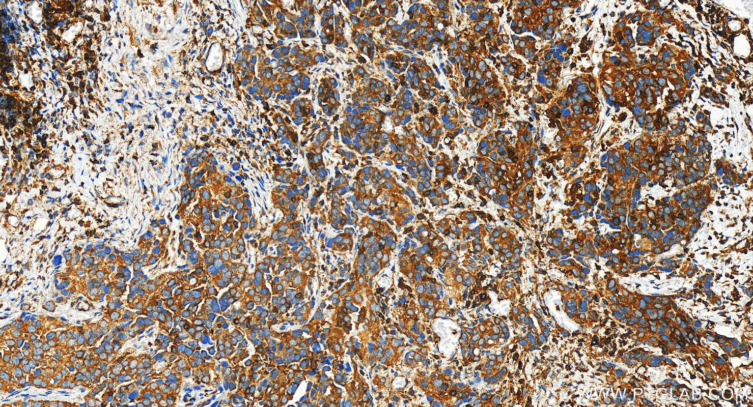 IHC staining of human ovary cancer using 31553-1-AP