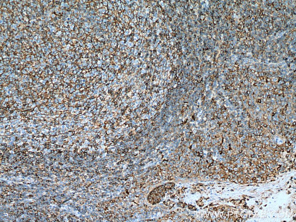 IHC staining of human tonsillitis using 66606-1-Ig