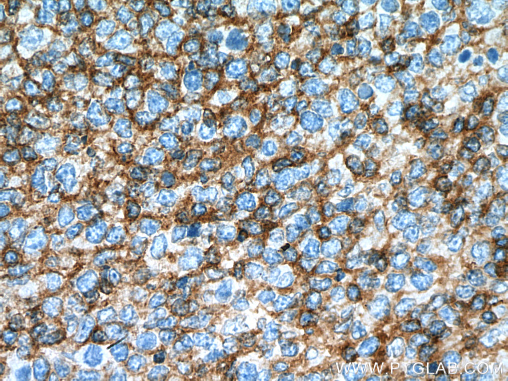 IHC staining of human tonsillitis using 66606-1-Ig (same clone as 66606-1-PBS)