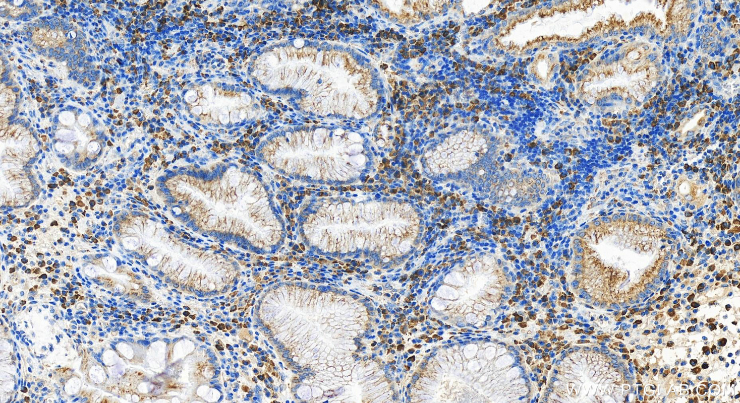 IHC staining of human stomach cancer using 21519-1-AP