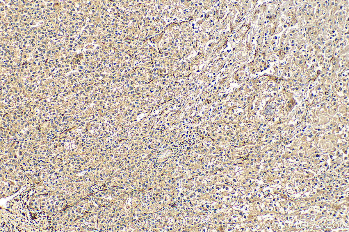 IHC staining of human endometrial cancer using 66325-1-Ig