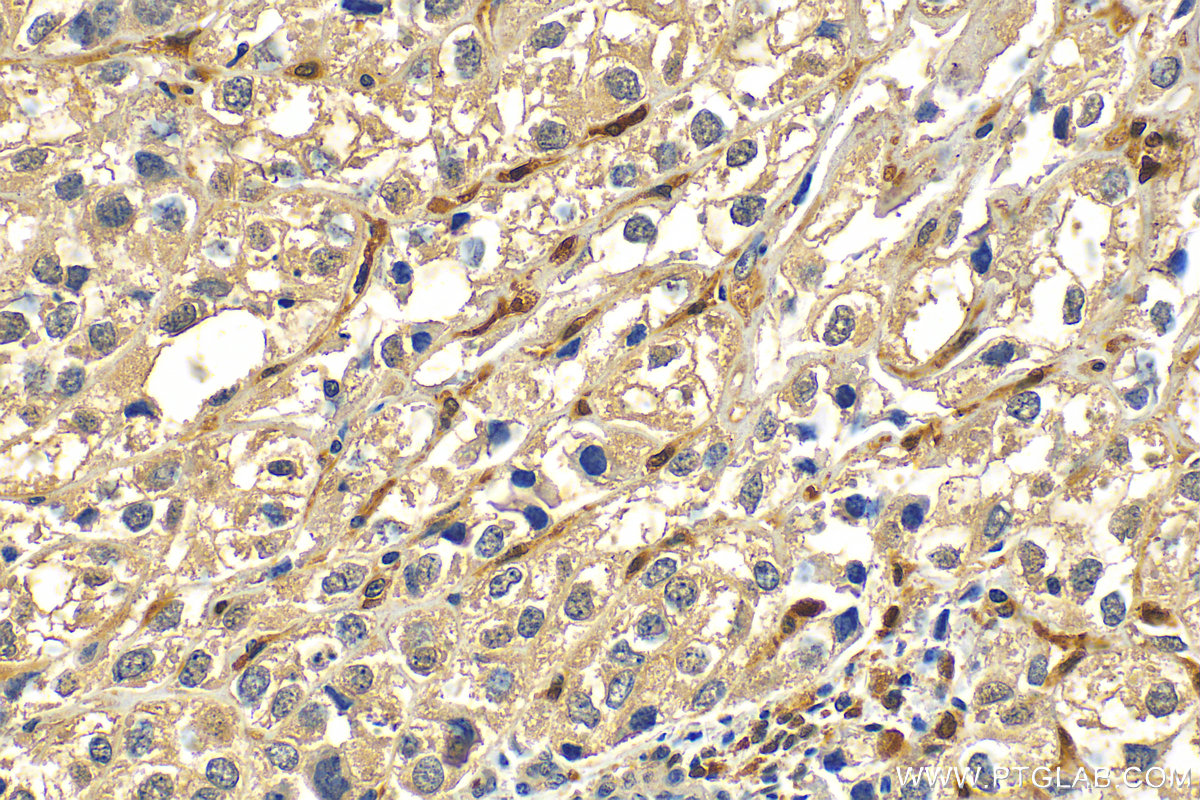 IHC staining of human endometrial cancer using 66325-1-Ig