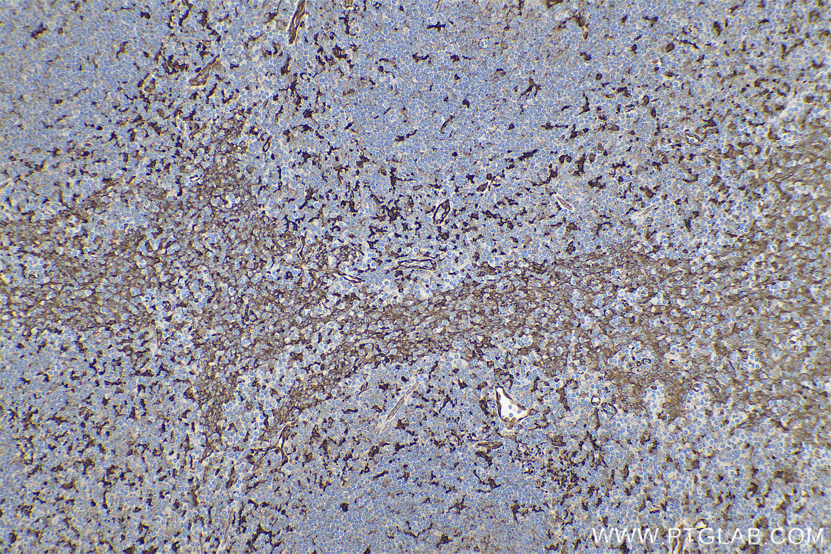 IHC staining of human tonsillitis using 66321-1-Ig