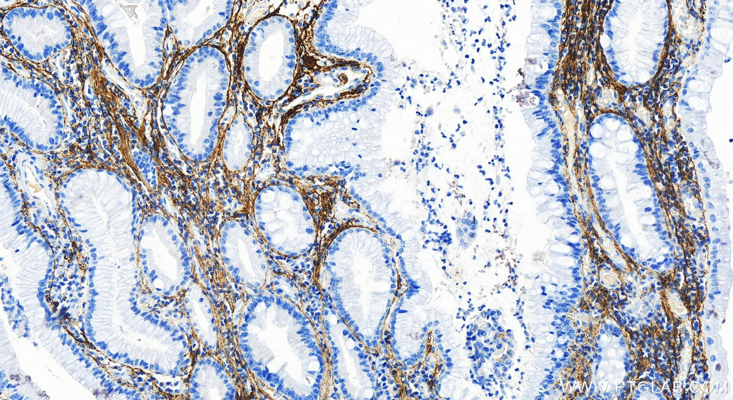 IHC staining of human stomach cancer using 83836-4-RR