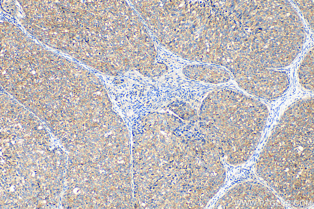 IHC staining of human breast cancer using 27596-1-AP