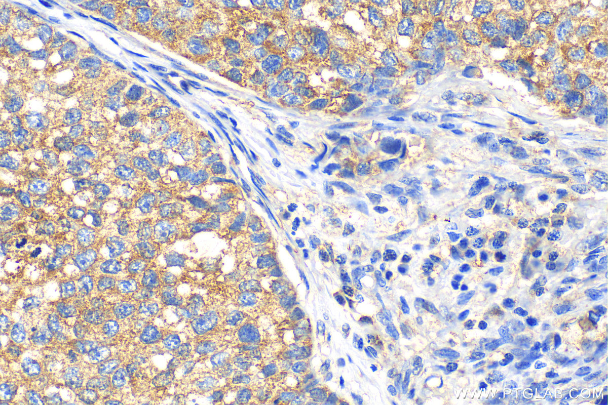 IHC staining of human breast cancer using 27596-1-AP