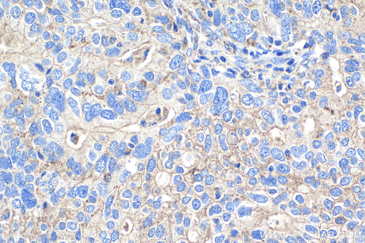 IHC staining of human ovary tumor using 67968-1-Ig