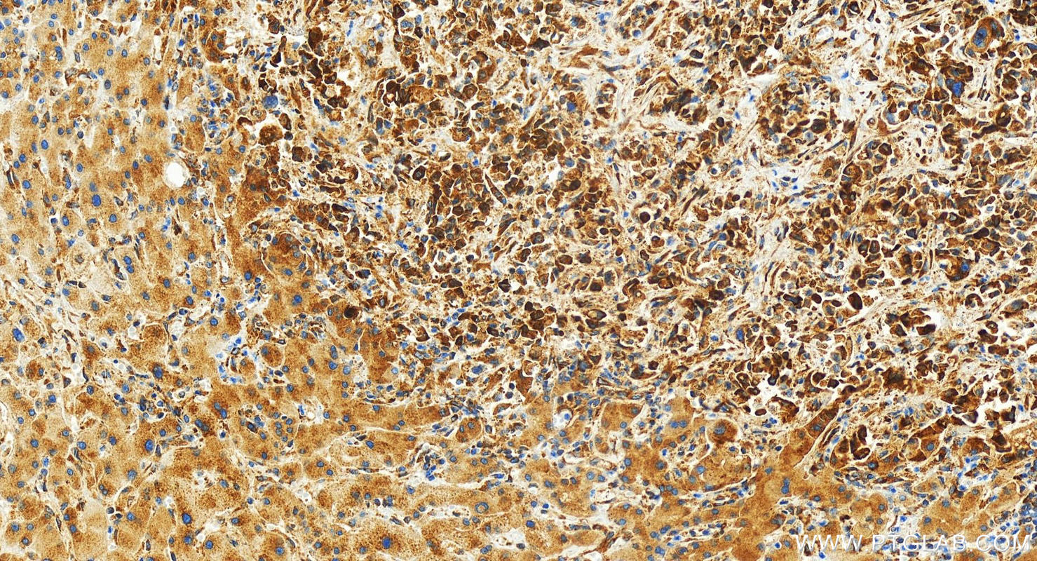 IHC staining of human intrahepatic cholangiocarcinoma using 82080-4-RR