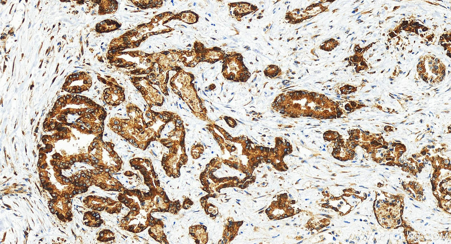 IHC staining of human intrahepatic cholangiocarcinoma using 82080-4-RR